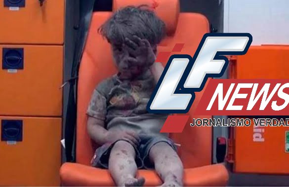  Imagem de criança ferida após ataque em Aleppo choca o mundo